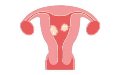 Heavy periods and intermenstrual bleeding