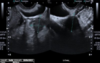 What does a pregnancy of uncertain viability mean?