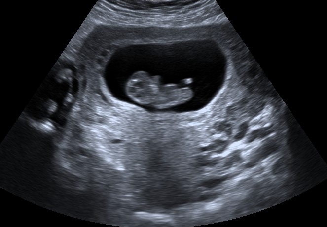 Your Safety, Our Priority: Why You Can Trust Somerset Early Scans